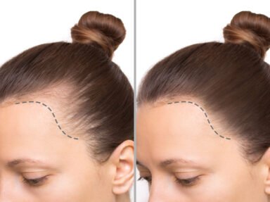 Chute de cheveux : causes, solutions naturelles et soins efficaces