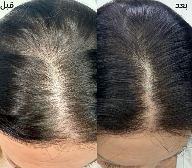 فوائد البروكابيل للشعر